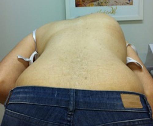 escoliose congenita 02