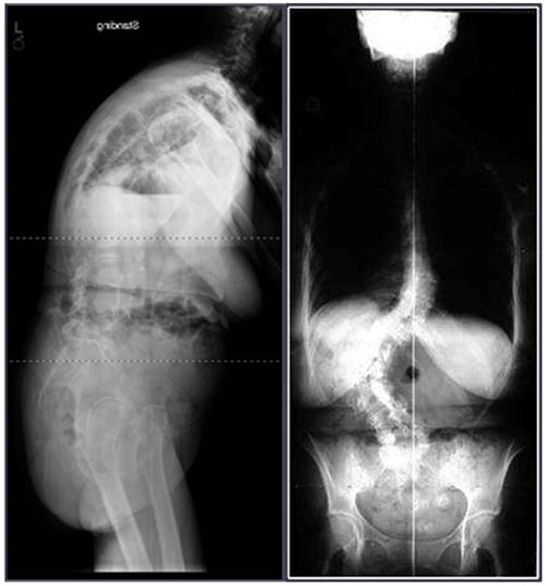 escoliose do adulto deformidade do adulto 1