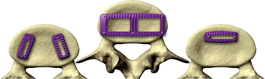 escoliose do adulto deformidade do adulto 5