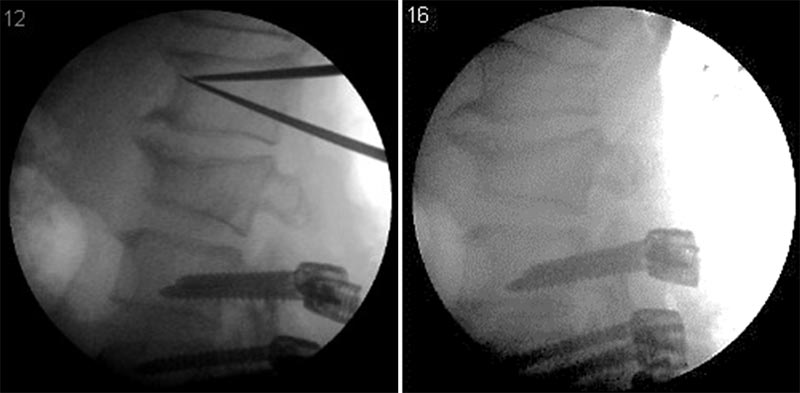 escoliose do adulto deformidade do adulto 6