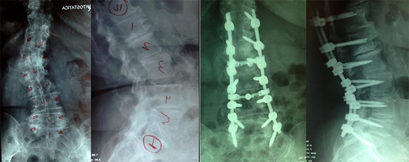 escoliose do adulto deformidade do adulto 7