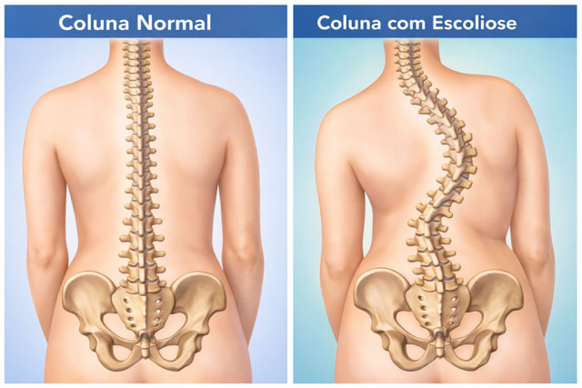 escoliose05