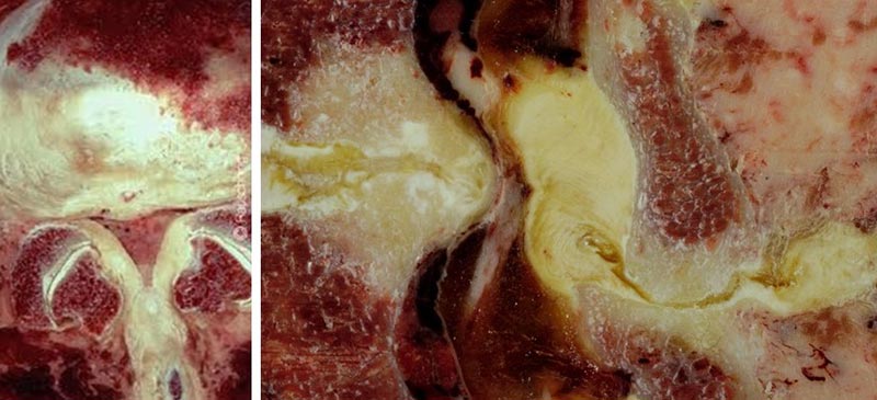 estenose do canal vertebral estenose lombar 1