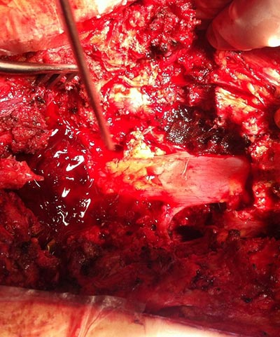 estenose do canal vertebral estenose lombar 3