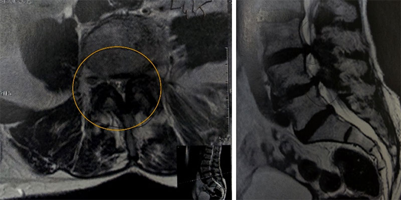 estenose do canal vertebral estenose lombar 6