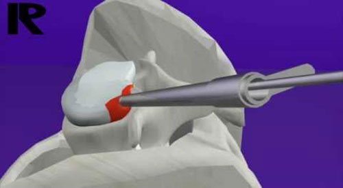 hernia discal lombar 4